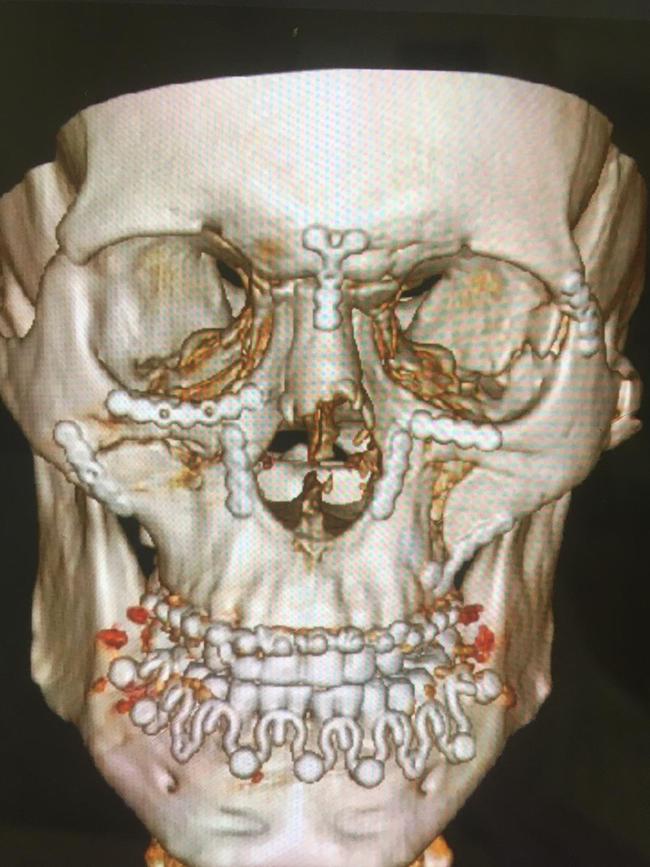 Titanium was implanted in Ricardo's face during his facial reconstruction.