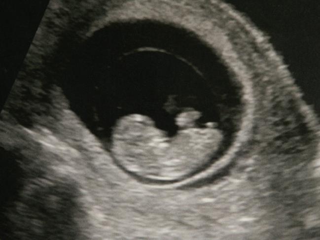 The ultrasound of foetus Zoe Ball taken in August 2009 before Ms Donegan was hit by an out of control van driven by Hampson.