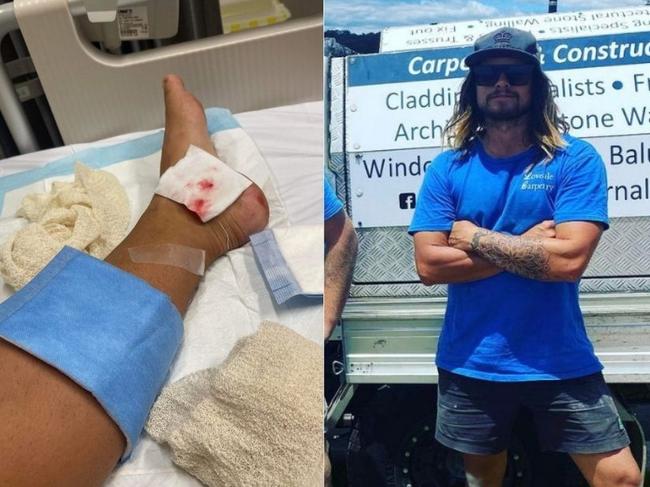 Tim McAndrew was bitten on the leg by a shark in chest-deep water at Crowdy Beach on August 15, 2022. Picture: Supplied