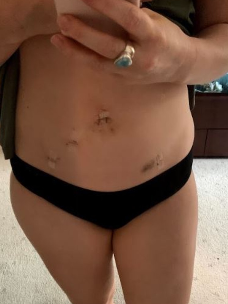 Jade's laparoscopy scars from her surgeries. Picture: Supplied