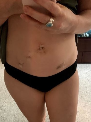 Jade's laparoscopy scars from her surgeries. Picture: Supplied