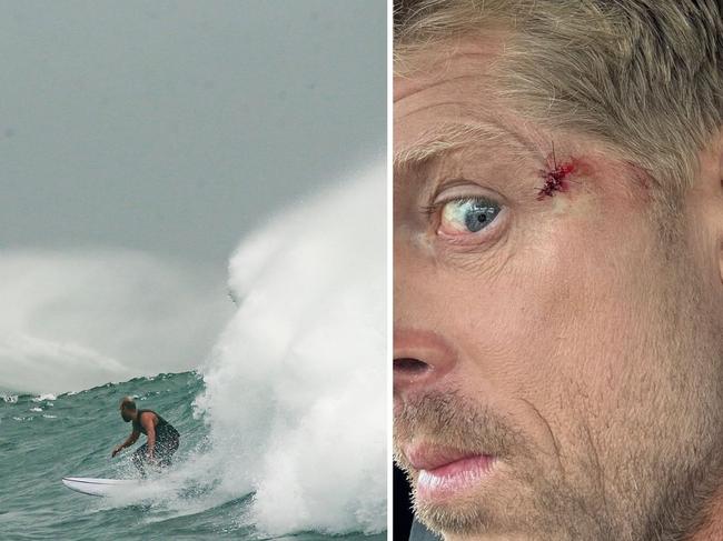 Surfing great injured in Cyclone Alfred waves