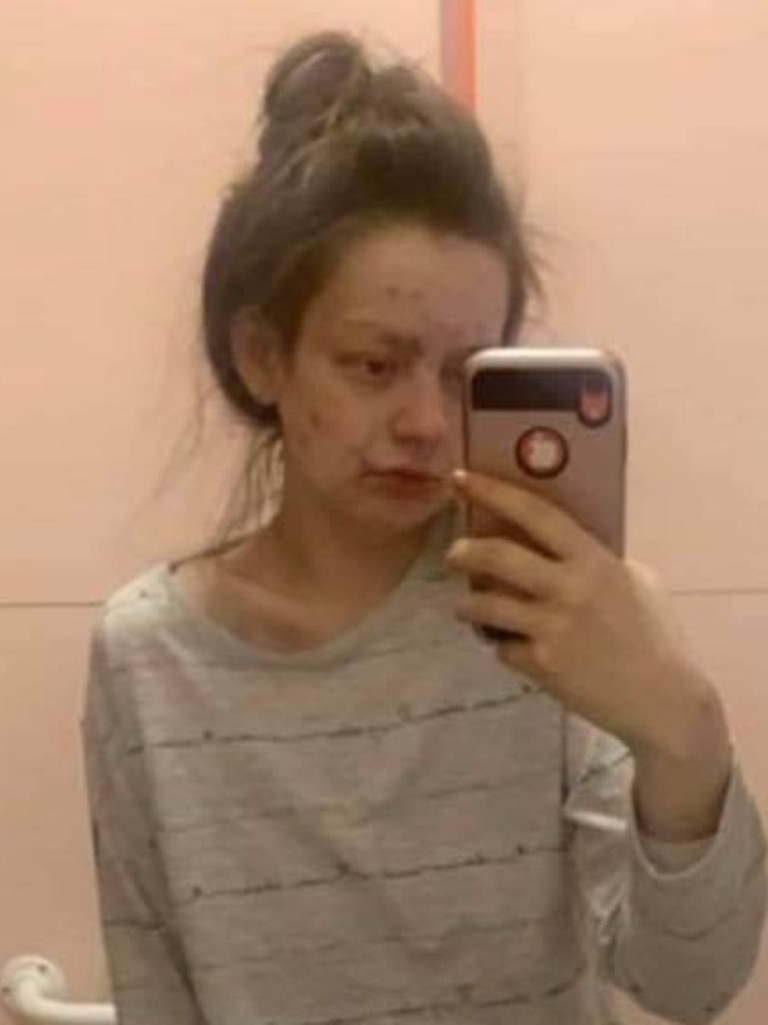 She wanted to share her ‘graphic’ before photos to give other addict’s hope that there is light at the end of a ‘dark place’. Picture: Facebook/Demi-Nicole Dunlop