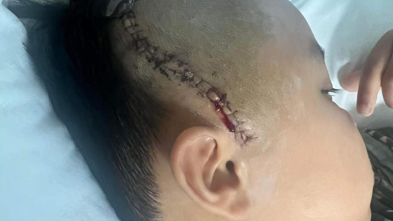 Jayden underwent emergency surgery for bleeding on the brain. Picture: Supplied