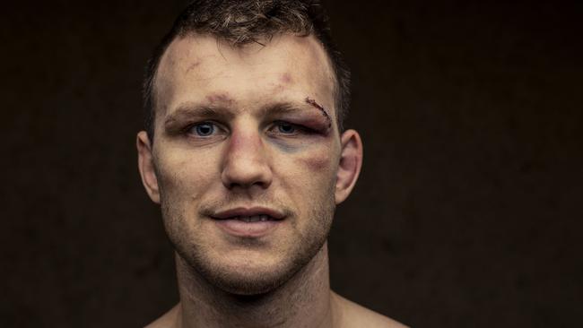 You should have seen the other guy: boxer Jeff Horn the day after defeating Michael Zerafa in Brisbane. Picture: Glenn Hunt