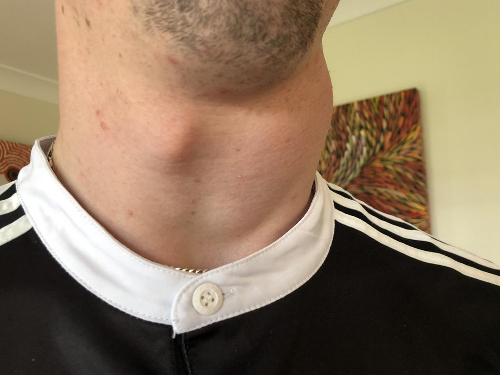 Shock diagnosis after 19yo finds lump on neck | The Chronicle