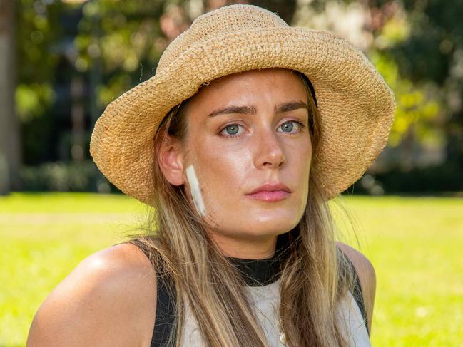 Imogen Hogan Stands as an advocate for regular skin & melanoma checks at Redfern park. Picture: Thomas Lisson