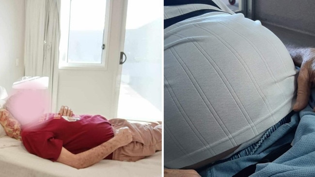 Photos taken two months apart show how extended the elderly man’s stomach became after not having a bowel movement for 18 days.