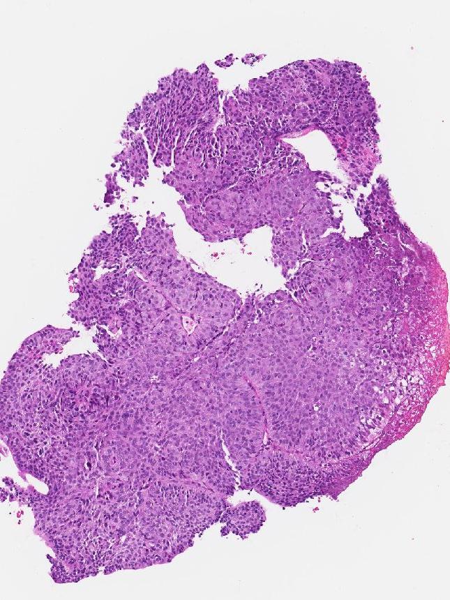 The 1.2mm "contaminant" piece of tissue which saw a pathology report returned leading to Mr Jackson have part of his lung removed. Picture: SA Coroner's Court