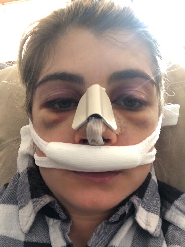 Nasal surgery The gruesome reality of the recovery process The Advertiser