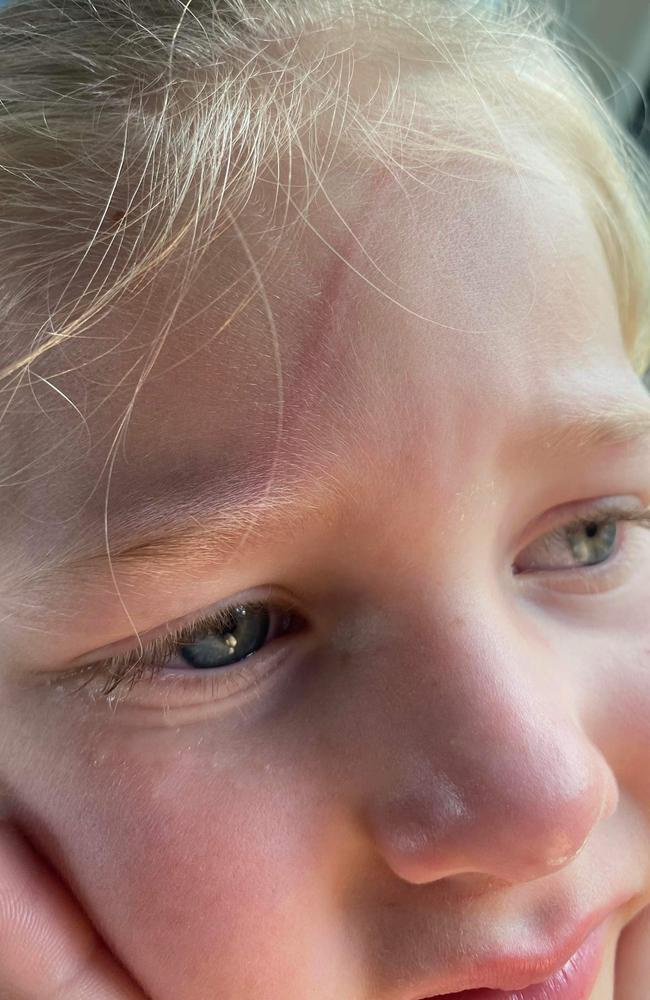 Close up on five-year-old Maci Neeve's injuries after a magpie swooped her at Mulherin Park, Mackay Harbour. Picture: Tianna Neeve