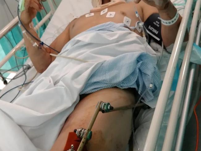 Kane Belle, 35, was lucky to survive when he crashed his motorbike in Longwarry on February 23, 2022 . The crash resulted in a compound fracture to his leg which he is still recovering from one year later. The young dad had bought his Harley Davidson bike during the pandemic and was new to riding road bikes. Picture: Supplied ,