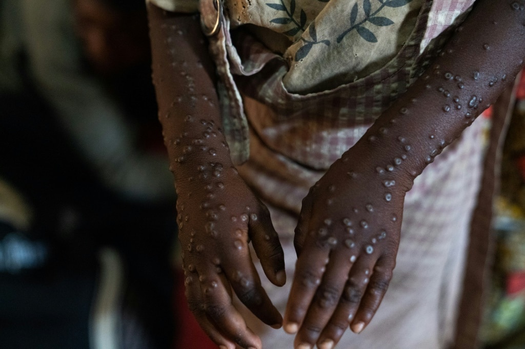 DR Congo launches mpox vaccination drive, hoping to curb outbreak