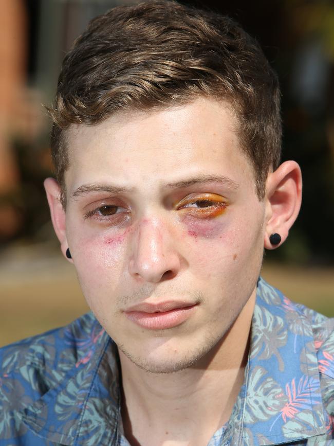 Joshua the day after the alleged attack. Picture Glenn Hampson