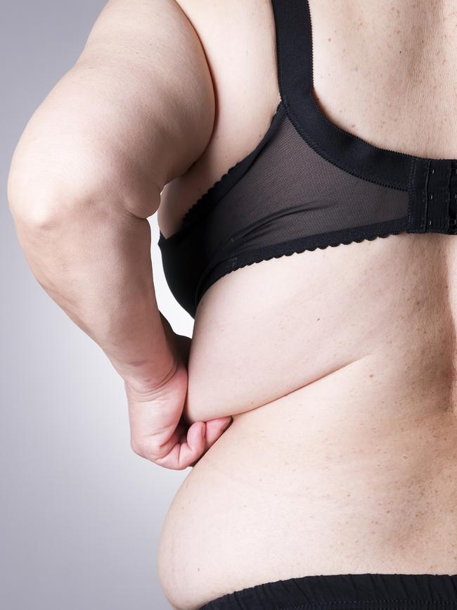 Lipedema has not previously been recognised as a specific disease, but considered as a form of obesity.