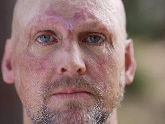 Matt Golinski endured numerous painful skin graft operations following the fire. Picture: ABC