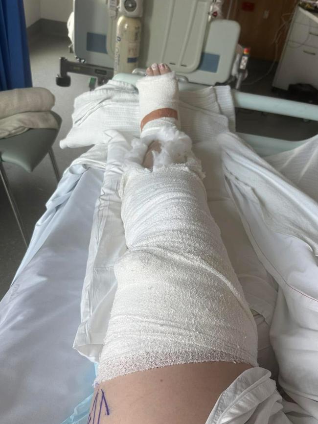 Tam Caspersz suffered leg injuries during a fell in Sydney. Picture: supplied