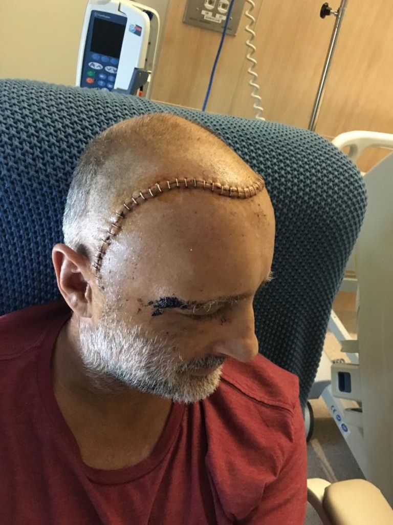 Angelo Hyder’s head injuries after a large tree fell on him. Picture: Supplied