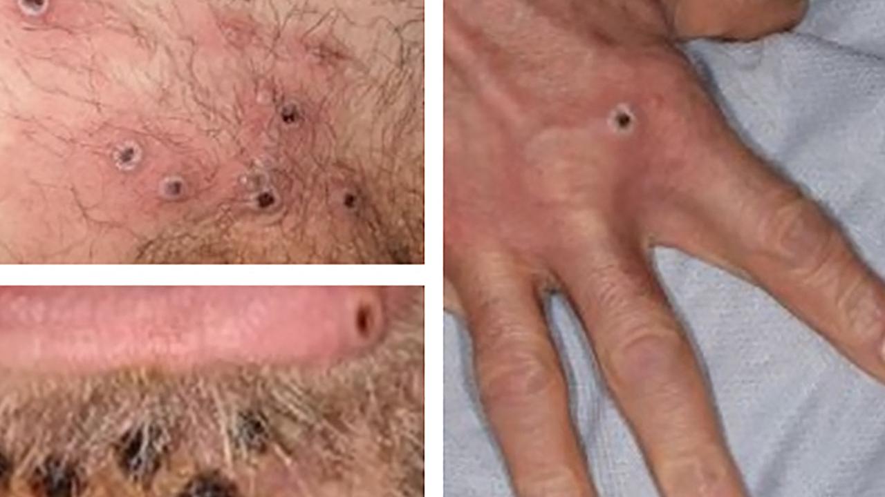 A collage of monkeypox rash lesions. Picture: UK Health Security Agency / AFP / UK HEALTH SECURITY AGENCY