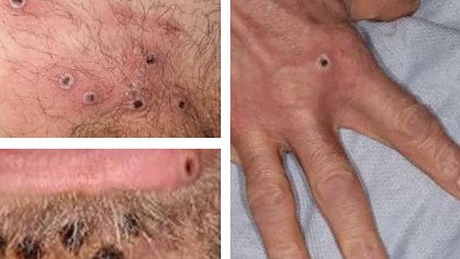 A collage of monkeypox rash lesions. Picture: UK Health Security Agency / AFP / UK HEALTH SECURITY AGENCY