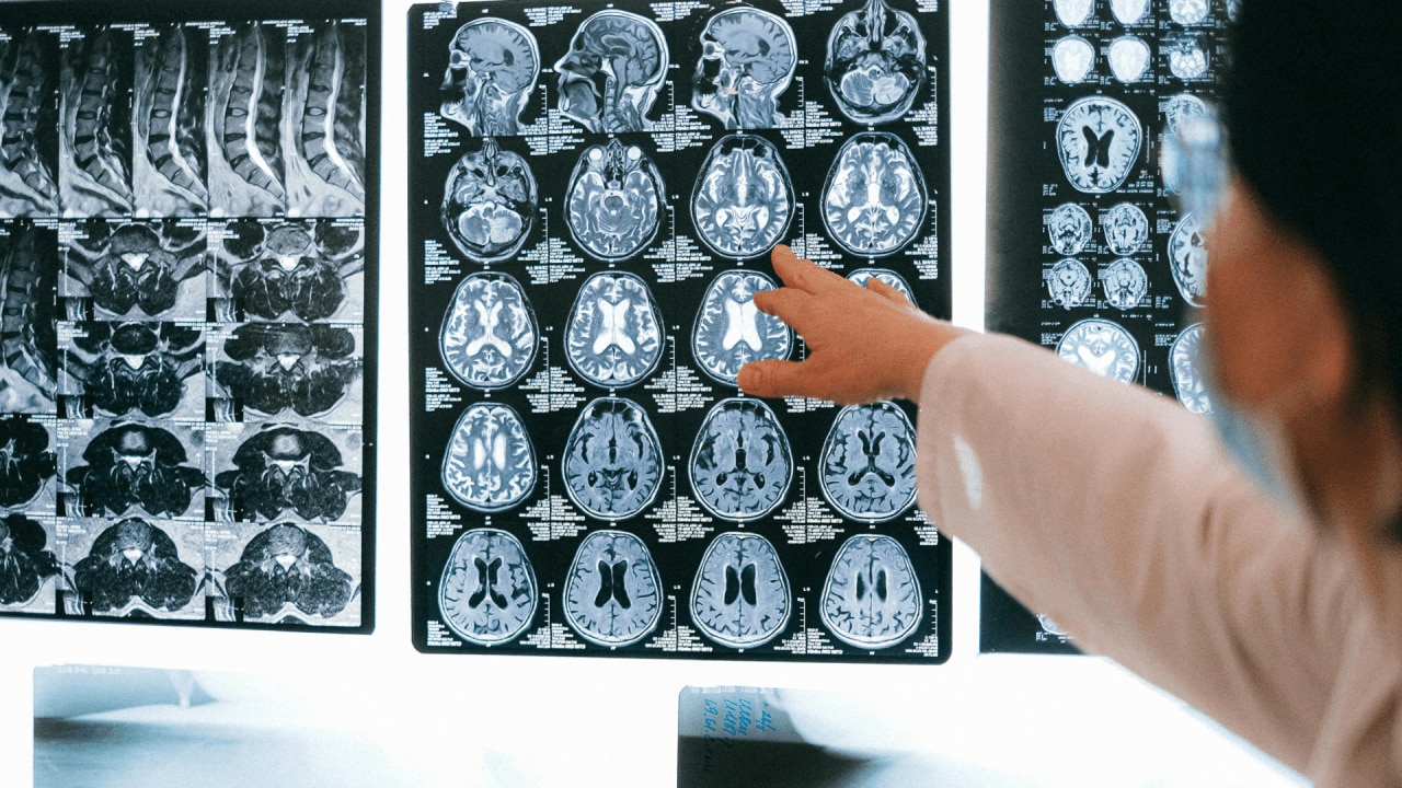 First-ever brain recording of dying human reveals what actually happens as  we die | Herald Sun
