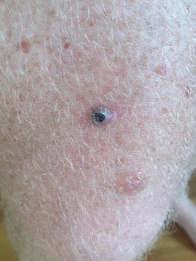 The melanoma on Matt Kean’s leg was stage three cancer.