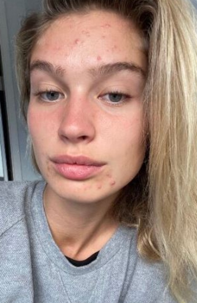 Australian model Harmony A’Bell, 21, has opened up about her year-long battle with acne. Picture: Instagram/Harmonyabell