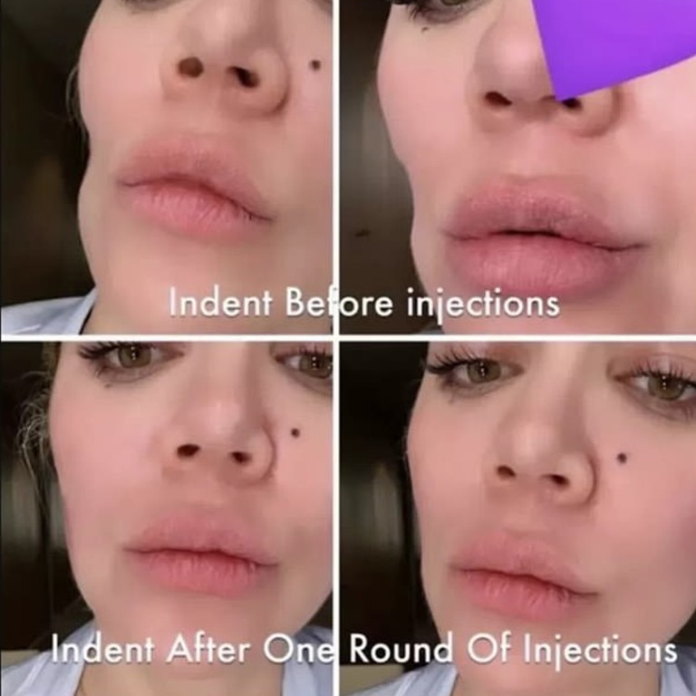 The reality star shared photos of the ‘indentation’ left by the cancer removal before and after facial injections. Picture: Snapchat