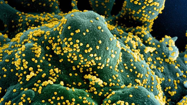 (FILES) In this undated handout image obtained July 15, 2020, courtesy of National Institute of Allergy and Infectious Diseases(NIH/NIAID), shows a colorized scanning electron micrograph of an apoptotic cell (blue/green) heavily infected with SARS-COV-2 virus particles (yellow), isolated from a patient sample, captured at the NIAID Integrated Research Facility (IRF) in Fort Detrick, Maryland. - US pharmaceutical company Eli Lilly's combination of two synthetic antibodies against Covid-19 reduced hospitalizations and deaths by 70 percent in high-risk patients with recent positive tests, the company said on January 26, 2021. "Bamlanivimab and etesevimab together have the potential to be an important treatment that significantly reduces hospitalizations and death in high-risk COVID-19 patients," Lilly's chief scientific officer Daniel Skovronsky said. (Photo by Handout / National Institute of Allergy and Infectious Diseases / AFP) / RESTRICTED TO EDITORIAL USE - MANDATORY CREDIT "AFP PHOTO /NATIONAL INSTITUTE OF ALLERGY AND INFECTIOUS DISEASES/HANDOUT " - NO MARKETING - NO ADVERTISING CAMPAIGNS - DISTRIBUTED AS A SERVICE TO CLIENTS