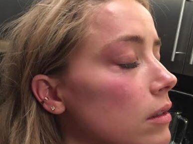 A photo showing Amber Heard with a “reddened” face was released by a London court. Picture: Supplied