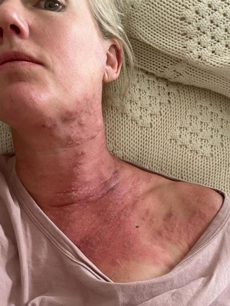 Jodie Oddy contracted shingles in Bali. Picture: Instagram / @jodieandhayesy