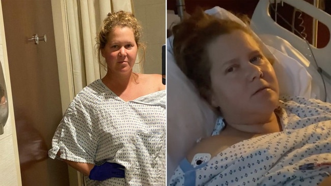 Amy Schumer had her appendix and uterus