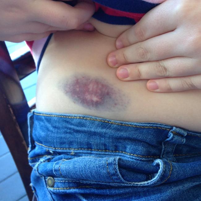 A bruise an anonymous homeschool graduate received from bullies pushing her into a desk and chair when she was in mainstream school