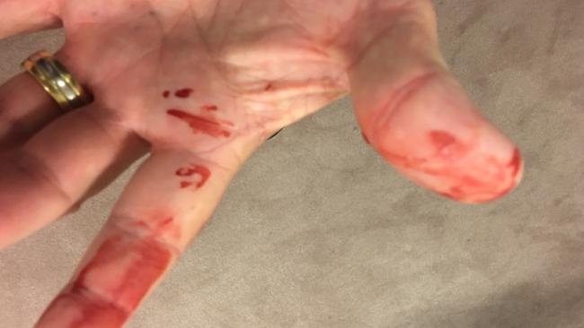 Burston provided images of his bloodied hand after claiming he was assaulted by Ashby. Brian Burston