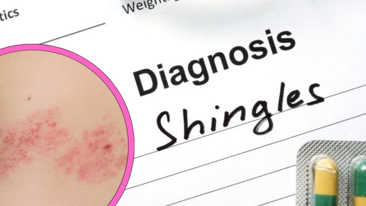 ‘So painful’: Ozempic users suffer shingles outbreaks
