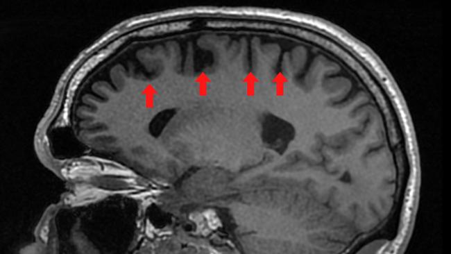 Graham’s brain scan with arrows identifying regions of low volume of the brain with black fluid-filled gaps.