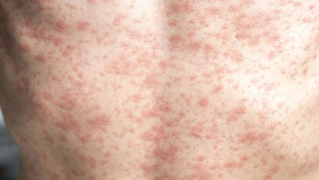 Public health alert: Potential measles exposure in Cairns. Picture: iStock.