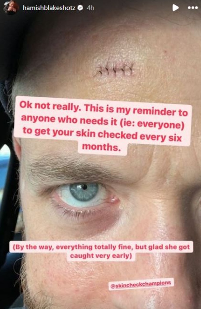 Blake urged his followers to get their skin checked.