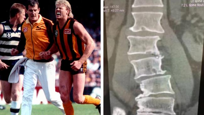 Dermott Brereton and the extent of his football injuries.