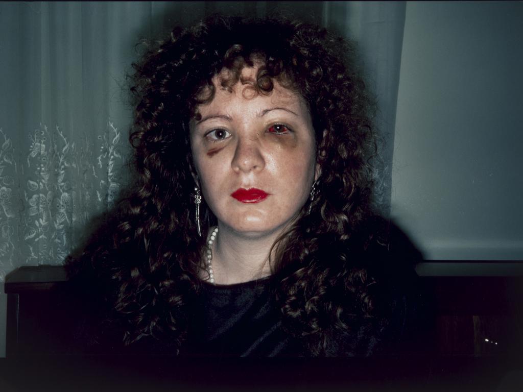 Nan Goldin Nan one month after being battered (1984), direct positive colour photograph, 39.0 h x 60.0 w cm, National Gallery of Australia, Canberra, Purchased 1994, © Nan Goldin, Courtesy Matthew Marks Gallery.