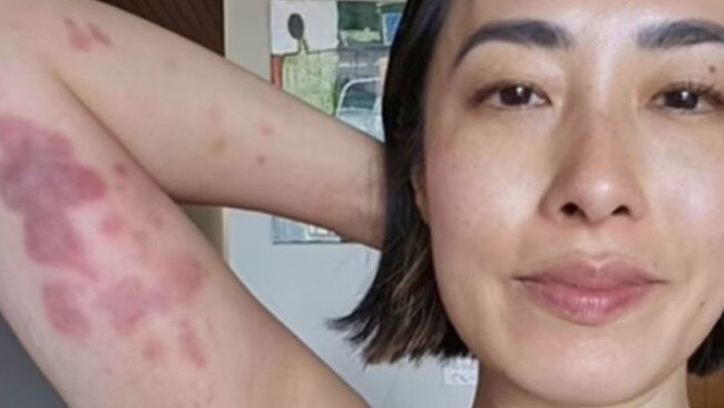 Melissa Leong shares shocking fight injuries