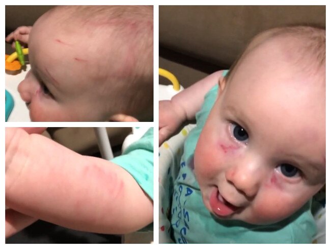 A Brisbane family claims their baby was injured by an older child at daycare.