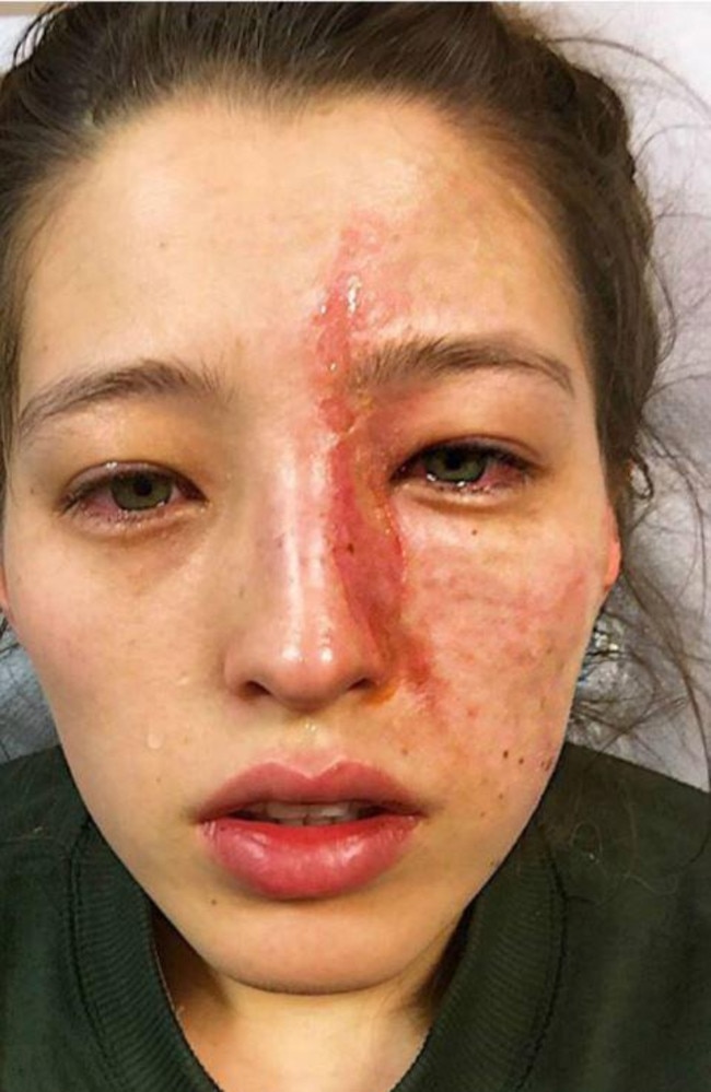 She suffered severe burns to her face.