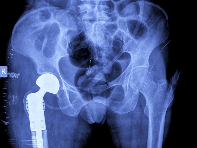 hip replacement x ray Picture: istock