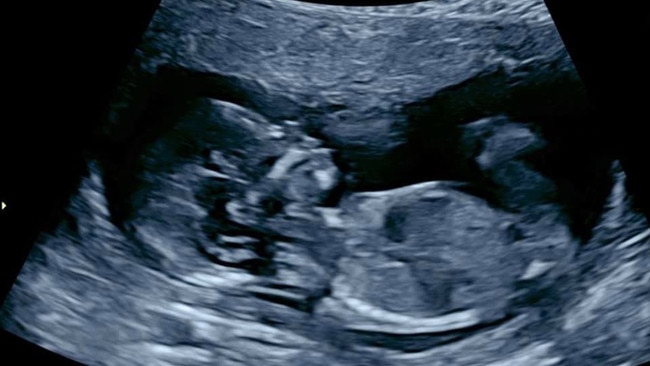 Townsville miracle babies - Our IVF baby is happily baking away because of Dr Beata. Photo: Kayleigh Wilkinson