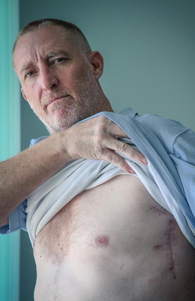 Gold Coast man Steve Gleeson shows the injuries he sustained. Picture: Glenn Campbell