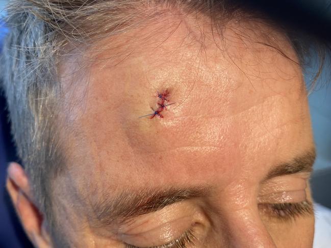 Mark Howard's head after getting stitches.