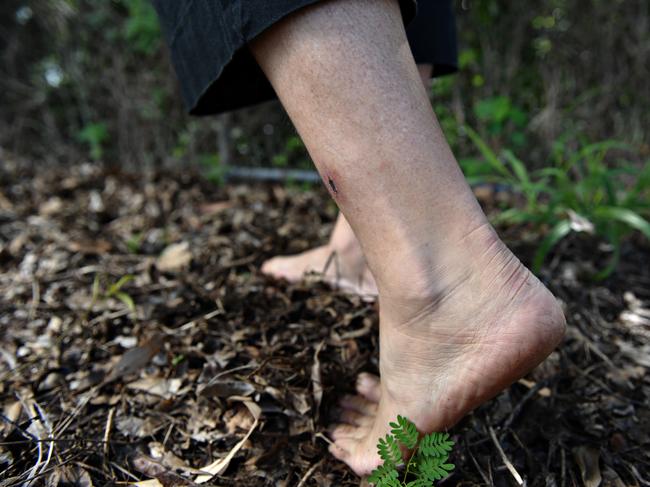 Nightcliff gardener's disease, soil-borne Melioidosis.