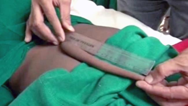 An unidentified Indian boy has had a 20cm ‘tail’ removed from his back. Picture: Caters News