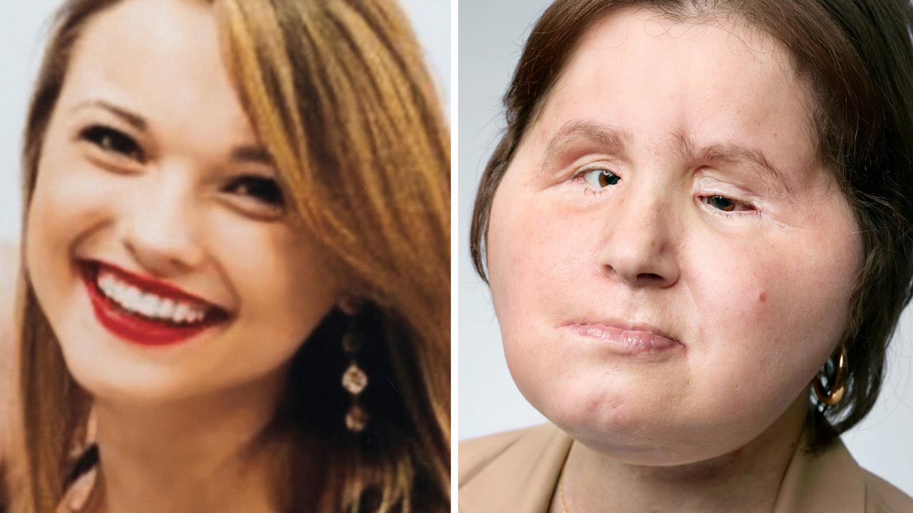 Face transplant Katie Stubblefield given second chance at life NT News